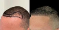 25-34 year old man treated with FUE Hair Transplant, Hair Transplant, NeoGraft