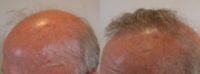 65-74 year old man treated with Hair Transplant