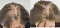 35-44 year old woman treated with Hair Loss Treatment, PRP for Hair Loss