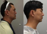 25-34 year old man treated with Jaw Reduction