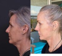 45-54 year old woman treated with Deep Plane Facelift, Neck Lift, Rhinoplasty, Eyelid Surgery