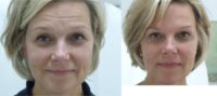 55-64 year old woman treated with Botox and filler