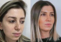 25-34 year old woman treated with Chin Implant