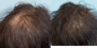 45-54 year old woman treated with Scalp Micropigmentation