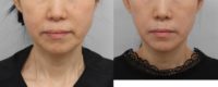 55-64 year old woman treated with SMAS Facelift, Facelift