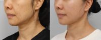 45-54 year old woman treated with Facelift, SMAS Facelift, Liposuction, Eyelid Surgery