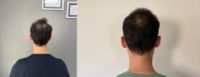 25-34 year old man treated with FUE Hair Transplant, Hair Loss Treatment, Hair Transplant, Hair Loss, Hair Restoration, Smile Ha