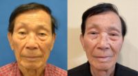 93 year old male underwent upper blepharoplasty