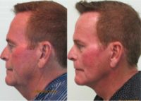 60+ year old man treated with Facelift