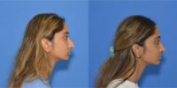 17 or under year old woman treated with Rhinoplasty