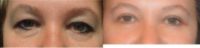35-44 year old woman treated with Eyelid Surgery (Upper & Lower Lid lift)