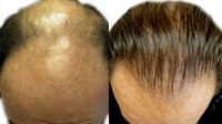 45 year old man treated with FUE Hair Transplant