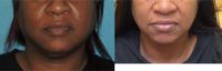 45-54 year old woman treated with Chin Liposuction