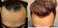 25-34 y.o. man treated with FUE Hair Transplant by Dr. Christopher Varona desired stronger hairline