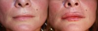 25-34 year old woman treated with Dermal Fillers