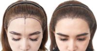 25-34 year old woman treated with FUE Hair Transplant