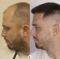 37 year old man treated with FUE Hair Transplant