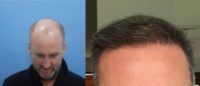 45-54 year old man treated with FUE Hair Transplant