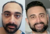 35-44 year old man treated with Hair Transplant