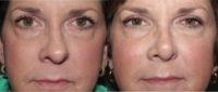 55-64 year old woman treated with Rhinoplasty