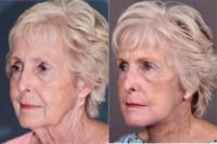 75 and up year old woman treated with Facelift
