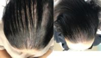 Patient treated with Hair Loss Treatment