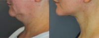 35-44 year old woman treated with Neck Lift