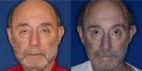75 and up year old man treated with Eyelid Surgery