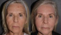 55-64 year old woman treated with Phenol Peel