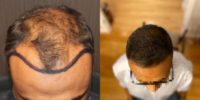35-44 years old man treated with Hair Transplant