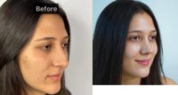 18-24 year old woman treated with Rhinoplasty