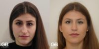 25-34 year old woman treated with Rhinoplasty