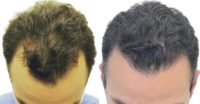 38 year old man treated with FUE Hair Transplant