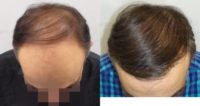 Dr. Jean Devroye, HTS Clinic / 5870 (3612+2258) FUT / 2 sessions, final results
