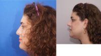 18-24 year old woman treated with MTF Facial Feminization Surgery