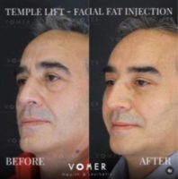 Man treated with Nonsurgical Facelift