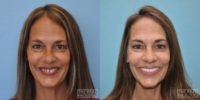 35-44 year old woman treated with All-on-4 Dental Implants