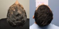 35-44 year old man treated with FUE Hair Transplant (4205 Grafts)