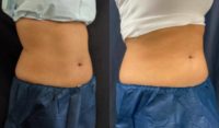 25-34 year old woman treated with WarmSculpting with SculpSure