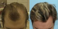 Man treated with FUE Hair Transplant