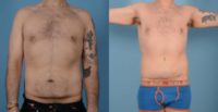 25-34 year old man treated with Male Tummy Tuck