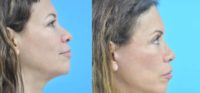 45-54 year old woman treated with Deep Plane Facelift, Eyelid Surgery, Facelift