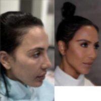 Woman treated with Hair Transplant