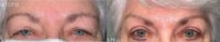 Woman treated with Brow Lift, Eyelid Surgery
