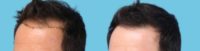 44 Year Old Male with Class III-V Hair Loss by Dr. Parsa Mohebi