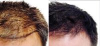 Man treated with Hair Transplant, PRP for Hair Loss