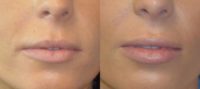 25-34 year old woman treated with Lip Implants