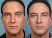 35-44 year old man treated with Sculptra Aesthetic