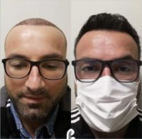 34 year old man treated with FUE Hair Transplant