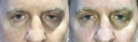 62 year old man treated with Ptosis Surgery